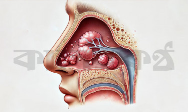 নাকের পলিপসের সমাধান কী?