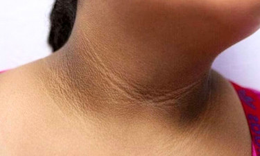 ঘাড়ে কালো দাগ কেন হয়, চিকিৎসা কী