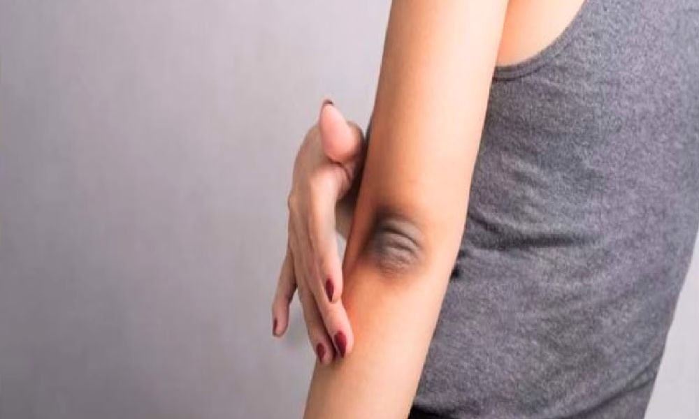 হাঁটু-কনুইয়ের কালো দাগ দূর করবেন যেভাবে