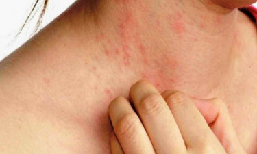 গরমে ফোড়া-ফুসকুড়ির সমস্যা কেন দেখা দেয়