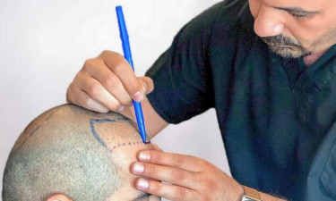 হেয়ার ট্রান্সপ্ল্যান্টে সতর্ক থাকবেন যে কারণে