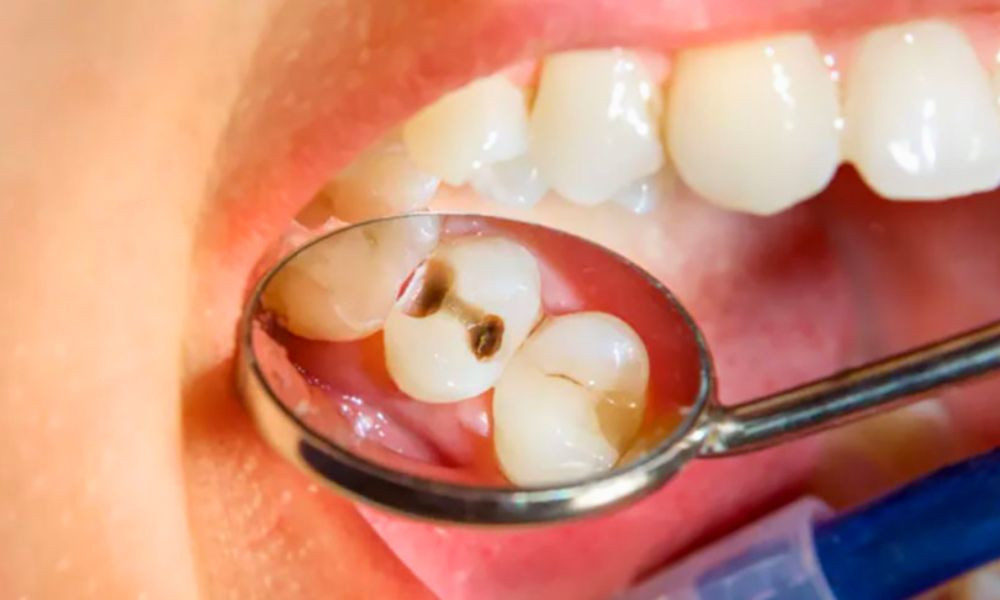 দাঁতে ছিদ্র হয় যে ভিটামিনের অভাবে