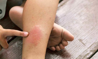 ত্বকের এই চার সমস্যা দূর করতে যা করবেন