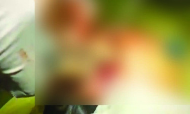 অপারেশনের তিন মাস পর রোগীর পেট থেকে বের হলো গজ !
