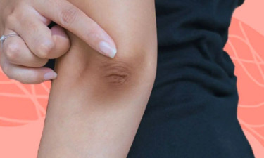 হাঁটু-কনুইয়ের কালো দাগ কিসের ইঙ্গিত?