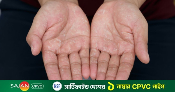 গরমে হাতের চামড়া উঠছে? জেনে নিন এর কারণ ও প্রতিকার