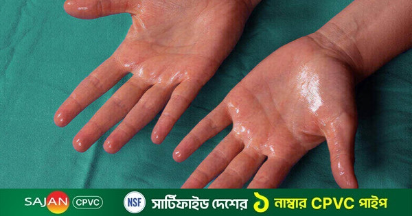 হাইপারহাইড্রোসিস : লক্ষণ ও কারণ