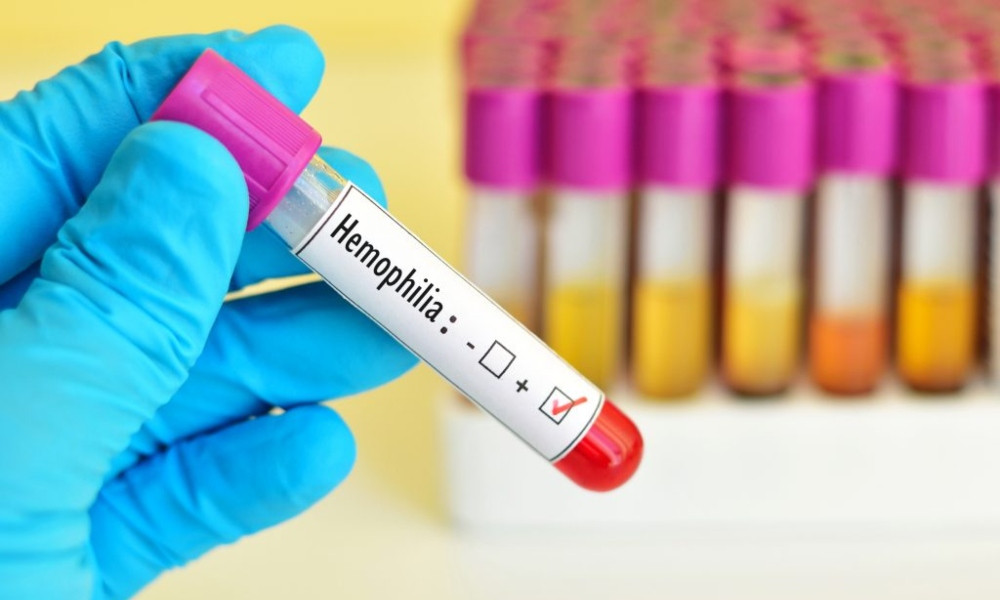 হিমোফিলিয়া কী? জানুন লক্ষণ ও প্রতিকার