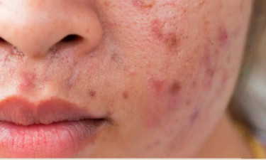 ব্রণ ও দাগের ঝামেলা? জেনে নিন প্রাকৃতিক সমাধান