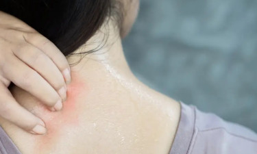 গরমে ত্বকের সুরক্ষায় ঘামাচি প্রতিরোধের উপায়