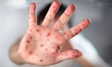 সিলেটে হাম উপসর্গে আরও ২ শিশুর মৃত্যু