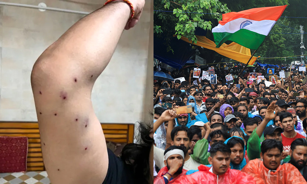 শরীরে ৩০টি পেলেট নিয়ে ক্ষতিপূরণ চান সাংবাদিক